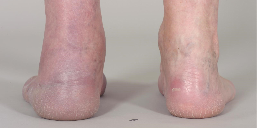 Blauwe Handen En Voeten Bij Ouderen